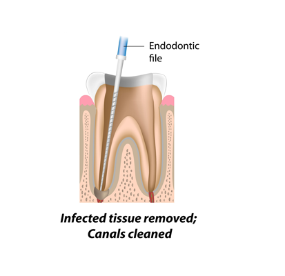 Rootcanal3
