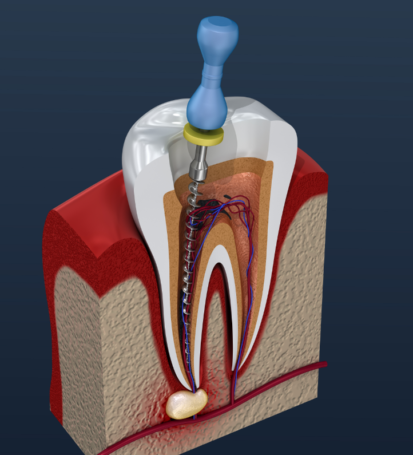 What is a dentist that specialises in Endodontic Treatment?