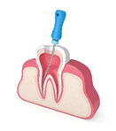 Cracked Tooth Treated