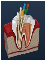 Root canal treatment