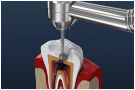 Root canal treatment 1