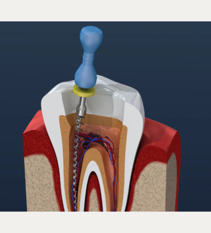 Root canal treatment