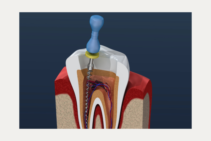 Root canal treatment – it’s not as painful as you think!