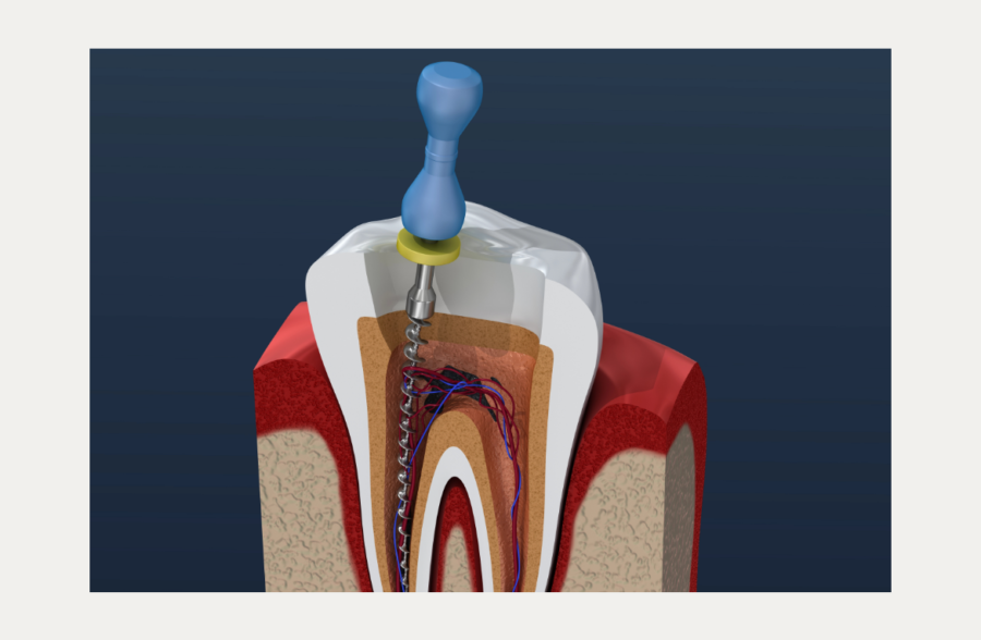 Root canal treatment