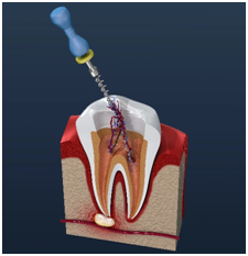 root canal procedure