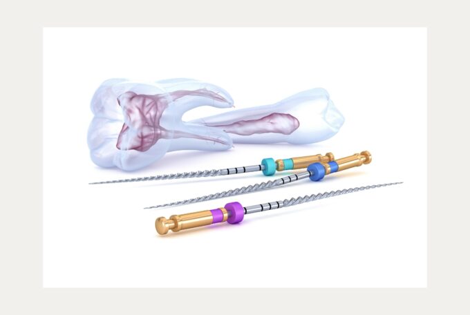 Root Canal Recovery: What to Expect After Treatment