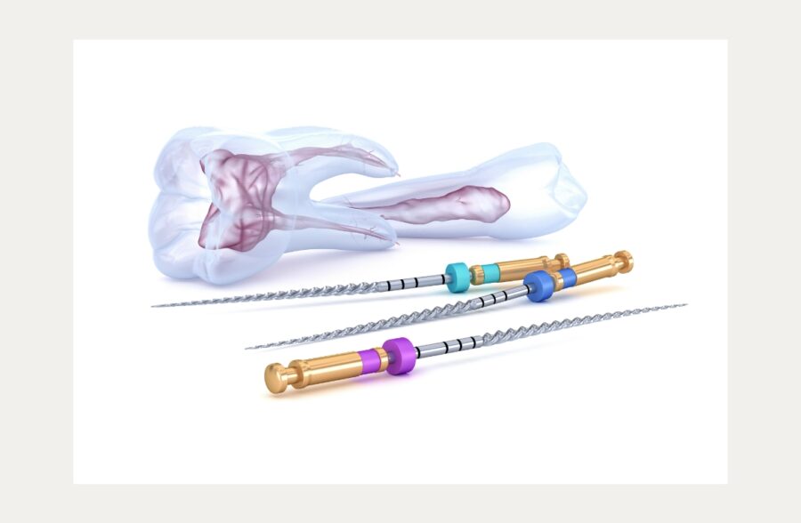 Root Canal Recovery